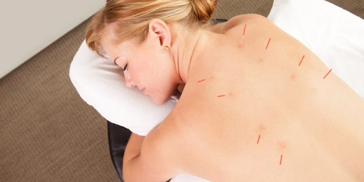 acupuncture for pain management NYC